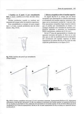 /Áreas de superposición 441
1. Cambios en el punto A por remodelación
ósea, es decir, cambios en la base alveolar única-
mente.
Pueden producirse cuando se realizan mo-
vimientos de torque sobre los incisivos superiores.
Esta remodelación es siempre de poca magni-
tud, 1 a 2 mm, y puede producirse aun sin creci-
miento (Fig. 18.12).
2. Efectos ortopédicos sobre el maxilar superior.
El ángulo Ba-Na-A se reduce por un efecto
ortopédico que básicamente se obtiene deteniendo
el crecimiento del maxilar superior, mientras el Na
sigue con su incremento normal de 1 mm por año.
Este mecanismo ortopédico logra mayores efectos
que el cambio por remodelación ya citado, y se
consigue mediante una variedad de recursos tera-
péuticos aplicados a pacientes en crecimiento
(FEO, extracciones, elásticos de Cl. II, etc.).
En la 2.da área de superposición se visualiza un
aparente retroceso del punto A. Esto no es real,
sino que es sólo la manifestación de la detención
del crecimiento del maxilar superior al haber
superpuesto los planos Ba-Na en Na. Esto ha sido
explicado gráficamente en la figura 18.13.
Fig. 18.12: Cambios del punto A por remodelación.
(Torque incisivo).
Fig. 18.13: Cambios ortopédicos del punto A. En A: crecimiento solamente. Superponiendo Ba-Na en CC, observamos
crecimiento a nivel del Na y del punto A. En B: si se detiene el crecimiento del maxilar superior; al superponer Ba-Na en
CC se visualiza el crecimiento en Na y detención del crecimiento en el maxilar superior. En C: el mismo efecto que en B;
visualizado en la 2a área de superposición: Ba-Na en Na. Al estar superpuestos los Na; se observa un aparente retroce-
so del punto A.
 