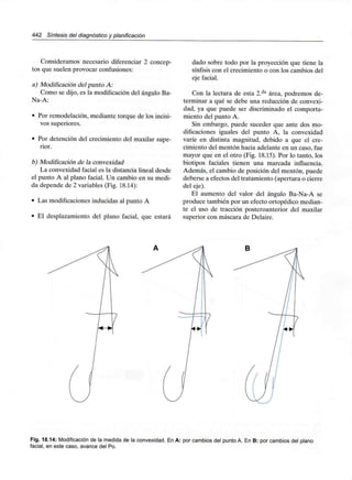 442 Síntesis del diagnóstico y planificación
Consideramos necesario diferenciar 2 concep-
tos que suelen provocar confusiones:
a) Modificación del punto A:
Como se dijo, es la modificación del ángulo Ba-
Na-A:
• Por remodelación, mediante torque de los incisi-
vos superiores.
• Por detención del crecimiento del maxilar supe-
rior.
b) Modificación de la convexidad
La convexidad facial es la distancia lineal desde
el punto A al plano facial. Un cambio en su medi-
da depende de 2 variables (Fig. 18.14):
• Las modificaciones inducidas al punto A
• El desplazamiento del plano facial, que estará
dado sobre todo por la proyección que tiene la
sínfisis con el crecimiento o con los cambios del
eje facial.
Con la lectura de esta 2.da área, podremos de-
terminar a qué se debe una reducción de convexi-
dad, ya que puede ser discriminado el comporta-
miento del punto A.
Sin embargo, puede suceder que ante dos mo-
dificaciones iguales del punto A, la convexidad
varíe en distinta magnitud, debido a que el cre-
cimiento del mentón hacia adelante en un caso, fue
mayor que en el otro (Fig. 18.15). Por lo tanto, los
biotipos faciales tienen una marcada influencia.
Además, el cambio de posición del mentón, puede
deberse a efectos del tratamiento (apertura o cierre
del eje).
El aumento del valor del ángulo Ba-Na-A se
produce también por un efecto ortopédico median-
te el uso de tracción posteroanterior del maxilar
superior con máscara de Delaire.
Fig. 18.14: Modificación de la medida de la convexidad. En A: por cambios del punto A. En B: por cambios del plano
facial, en este caso, avance del Po.
 