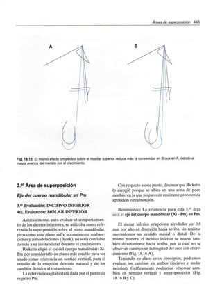 Áreas de superposición 443
Fig. 18.15: El mismo efecto ortopédico sobre el maxilar superior reduce más la convexidad en B que en A, debido al
mayor avance del mentón por el crecimiento.
3.er Área de superposición
Eje del cuerpo mandibular en Pm
3.er Evaluación: INCISIVO INFERIOR
4ta. Evaluación: MOLAR INFERIOR
Anteriormente, para evaluar el comportamien-
to de los dientes inferiores, se utilizaba como refe-
rencia la superposición sobre el plano mandibular;
pero como este plano sufre normalmente reabsor-
ciones y remodelaciones (Bjork), no sería confiable
debido a su inestabilidad durante el crecimiento.
Ricketts eligió el eje del cuerpo mandibular: Xi-
Pm por considerarlo un plano más estable para ser
usado como referencia en sentido vertical, para el
estudio de la erupción dentaria natural y de los
cambios debidos al tratamiento.
La referencia sagital estará dada por el punto de
registro Pm.
Con respecto a este punto, diremos que Ricketts
lo escogió porque se ubica en una zona de poco
cambio, en la que no parecen realizarse procesos de
aposición o reabsorción.
Resumiendo: La referencia para esta 3.er área
será el eje del cuerpo mandibular (Xi - Pm) en Pm.
El molar inferior erupciona alrededor de 0,8
mm por año en dirección hacia arriba, sin realizar
movimientos en sentido mesial o distal. De la
misma manera, el incisivo inferior se mueve tam-
bién directamente hacia arriba, por lo cual no se
observan cambios en la longitud del arco con el cre-
cimiento (Fig. 18.16 A).
Teniendo en claro estos conceptos, podremos
evaluar los cambios en ambos (incisivo y molar
inferior). Gráficamente podremos observar cam-
bios en sentido vertical y anteroposterior (Fig.
18.16 B y C).
 