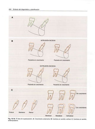 444 Síntesis del diagnóstico y planificación
B
INTRUSIÓN INCISIVA
Paciente en crecimiento Paciente sin crecimiento
EXTRUSIÓN INICISIVA
Paciente en crecimiento Paciente sin crecimiento
Protruir
I/
Mantener Retruir
=W/ Sin crecimiento
Con crecimiento
Mantener Mesializar Verticalizar
Fig. 18.16: 3a área de superposición. A: Crecimiento solamente. B: Cambios en sentido vertical. C: Cambios en sentido
anteroposterior.
 