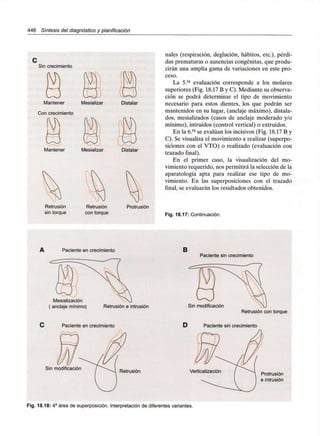 446 Síntesis del diagnóstico y planificación
Sin crecimiento
Mantener Mesializar Distalar
Con crecimiento
Mantener Mesializar Distalar
Retrusión
sin torque
Retrusión
con torque
Protrusión
nales (respiración, deglución, hábitos, etc.), pérdi-
das prematuras o ausencias congénitas, que produ-
cirán una amplia gama de variaciones en este pro-
ceso.
La 5.ta evaluación corresponde a los molares
superiores (Fig. 18.17 B y C). Mediante su observa-
ción se podrá determinar el tipo de movimiento
necesario para estos dientes, los que podrán ser
mantenidos en su lugar, (anclaje máximo), distala-
dos, mesializados (casos de anclaje moderado y/o
mínimo), intruidos (control vertical) o extruidos.
En la 6.ta se evalúan los incisivos (Fig. 18.17 B y
C). Se visualiza el movimiento a realizar (superpo-
siciones con el VTO) o realizado (evaluación con
trazado final).
En el primer caso, la visualización del mo-
vimiento requerido, nos permitirá la selección de la
aparatología apta para realizar ese tipo de mo-
vimiento. En las superposiciones con el trazado
final, se evaluarán los resultados obtenidos.
Fig. 18.17:Continuación.
Paciente en crecimiento
Mesialización
anclaje mínimo) Retrusión e intrusión
Paciente en crecimiento
Sin modificación
Retrusión
B
Paciente sin crecimiento
Sin modificación
Retrusión con torque
D Paciente sin crecimiento
Verticalización
Protrusión
e intrusión
Fig. 18.18: 4a área de superposición. Interpretación de diferentes variantes.
 