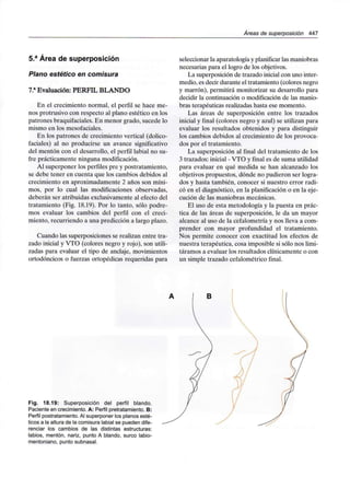/Áreas de superposición 447
5.a Área de superposición
Plano estético en comisura
7.a Evaluación: PERFIL BLANDO
En el crecimiento normal, el perfil se hace me-
nos protrusivo con respecto al plano estético en los
patrones braquifaciales. En menor grado, sucede lo
mismo en los mesofaciales.
En los patrones de crecimiento vertical (dolico-
faciales) al no producirse un avance significativo
del mentón con el desarrollo, el perfil labial no su-
fre prácticamente ninguna modificación.
Al superponer los perfiles pre y postratamiento,
se debe tener en cuenta que los cambios debidos al
crecimiento en aproximadamente 2 años son míni-
mos, por lo cual las modificaciones observadas,
deberán ser atribuidas exclusivamente al efecto del
tratamiento (Fig. 18.19). Por lo tanto, sólo podre-
mos evaluar los cambios del perfil con el creci-
miento, recurriendo a una predicción a largo plazo.
Cuando las superposiciones se realizan entre tra-
zado inicial y VTO (colores negro y rojo), son utili-
zadas para evaluar el tipo de anclaje, movimientos
ortodóncicos o fuerzas ortopédicas requeridas para
seleccionar la aparatología y planificarlas maniobras
necesarias para el logro de los objetivos.
La superposición de trazado inicial con uno inter-
medio, es decir durante el tratamiento (colores negro
y marrón), permitirá monitorizar su desarrollo para
decidir la continuación o modificación de las manio-
bras terapéuticas realizadas hasta ese momento.
Las áreas de superposición entre los trazados
inicial y final (colores negro y azul) se utilizan para
evaluar los resultados obtenidos y para distinguir
los cambios debidos al crecimiento de los provoca-
dos por el tratamiento.
La superposición al final del tratamiento de los
3 trazados: inicial - VTO y final es de suma utilidad
para evaluar en qué medida se han alcanzado los
objetivos propuestos, dónde no pudieron ser logra-
dos y hasta también, conocer si nuestro error radi-
có en el diagnóstico, en la planificación o en la eje-
cución de las maniobras mecánicas.
El uso de esta metodología y la puesta en prác-
tica de las áreas de superposición, le da un mayor
alcance al uso de la cefalometría y nos lleva a com-
prender con mayor profundidad el tratamiento.
Nos permite conocer con exactitud los efectos de
nuestra terapéutica, cosa imposible si sólo nos limi-
táramos a evaluar los resultados clínicamente o con
un simple trazado cefalométrico final.
Fig. 18.19: Superposición del perfil blando.
Paciente en crecimiento.A: Perfil pretratamiento. B:
Perfil postratamiento. Al superponer los planosesté-
ticos a la altura de la comisura labial se puedendife-
renciar los cambios de las distintas estructuras:
labios, mentón, nariz, punto A blando, surco labio-
mentoniano, punto subnasal.
 