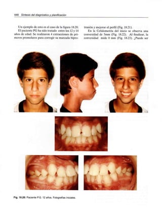 448 Síntesis del diagnóstico y planificación
Un ejemplo de esto es el caso de la figura 18.20.
El paciente PG ha sido tratado entre los 12y 14
años de edad. Se realizaron 4 extracciones de pri-
meros premolares para corregir su marcada bipro-
trusión y mejorar el perfil (Fig. 18.21).
En la Cefalometría del inicio se observa una
convexidad de 5mm (Fig. 18.22). Al finalizar, la
convexidad mide O mm (Fig. 18.23). ¿Puede ser
Fig. 18.20: Paciente P.G. 12 años. Fotografíasiniciales.
 