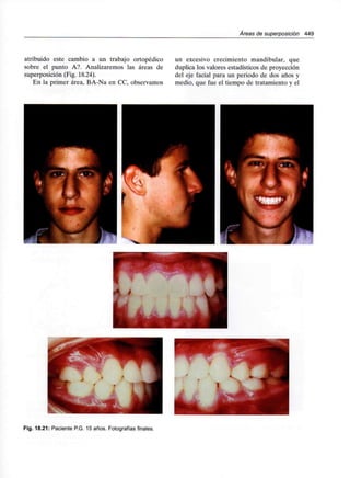 /Áreas de superposición 449
atribuido este cambio a un trabajo ortopédico
sobre el punto A?. Analizaremos las áreas de
superposición (Fig. 18.24).
En la primer área, BA-Na en CC, observamos
un excesivo crecimiento mandibular, que
duplica los valores estadísticos de proyección
del eje facial para un periodo de dos años y
medio, que fue el tiempo de tratamiento y el
Fig. 18.21: Paciente P.G. 15 años. Fotografías finales.
 