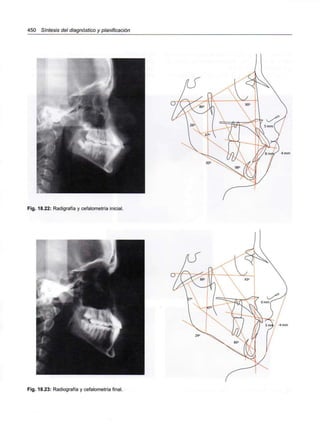 450 Síntesis del diagnóstico y planificación
4mm
Fig. 18.22: Radigrafía y cefalometría inicial.
Fig. 18.23: Radiografía y cefalometría final.
 