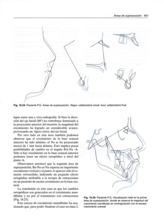 /Áreas de superposición 451
Fig. 18.24: Paciente P.G. Áreas de superposición. Negro: cefalometría inicial.Azul: cefalometría final.
lapso entre una y otra radiografía. Si bien la direc-
ción del eje facial (88°) no contribuye demasiado a
la proyección anterior del mentón, la magnitud del
crecimiento ha logrado un considerable avance,
provocando un ligero cierre del eje facial.
Por otro lado en esta área también podemos
observar que el crecimiento de la base craneal
anterior ha sido mínimo, el Na se ha proyectado
menos de 1 mm hacia delante. Esto implica pocas
posibilidades de cambio en el ángulo BA-Na -A.
Sólo si hay crecimiento en la base craneal anterior
podemos tener un efecto ortopédico a nivel del
punto A.
Observamos entonces que la segunda área de
superposición, Ba-Na en Na expresa un importante
crecimiento vertical y el punto A aparece sólo leve-
mente retrocedido, indicando un pequeño efecto
ortopédico atribuible a la terapia de extracciones
en un paciente de escaso crecimiento en la base cra-
neal.
La conclusión en este caso es que los cambios
ortopédicos son generados en el crecimiento man-
dibular y no por el tratamiento con extracciones
(Fig. 18.25).
Este exceso de crecimiento mandibular ha oca-
sionado que, para poder finalizar el caso en clase I,
Fig. 18.25: Paciente P.G. Visualizacióntotal en la primer
área de superposición, donde se observa la magnitud del
crecimiento mandibular en contraposición con el escaso
crecimiento craneal.
 