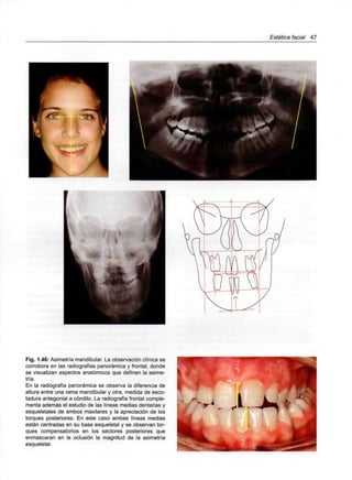 Estética facial 47
Fig. 1.46: Asimetría mandibular. La observación clínica se
corrobora en las radiografías panorámica y frontal, donde
se visualizan aspectos anatómicos que definen la asime-
tría.
En la radiografía panorámica se observa la diferencia de
altura entre una rama mandibular y otra, medida de esco-
tadura antegonial a cóndilo. La radiografía frontal comple-
menta además el estudio de las líneas medias dentarias y
esqueletales de ambos maxilares y la apreciación de los
tonques posteriores. En este caso ambas líneas medias
están centradas en su base esqueletal y se observan tor-
ques compensatorios en los sectores posteriores que
enmascaran en la oclusión la magnitud de la asimetría
esqueletal.
 