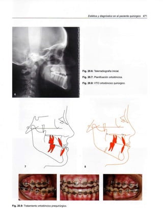 Estética y diagnóstico en el paciente quirúrgico 471
Fig. 20.6: Telerradiografía inicial.
Fig. 20.7: Planificación ortodóncica.
Fig. 20.8: VTO ortodóncico quirúrgico.
"•
Fig. 20.9: Tratamiento ortodóncico prequirúrgico.
 