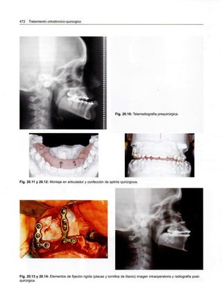 472 Tratamiento ortodóncico-quirúrgico
Fig. 20.10: Telerradiografía prequirúrgica.
Fig. 20.11 y 20.12: Montaje en articulador y confección de splints quirúrgicos.
Fig. 20.13 y 20.14: Elementos de fijación rigída (placas y tornillos de titanio) imagen intraoperatoria y radiografía post-
quirúrgica.
 