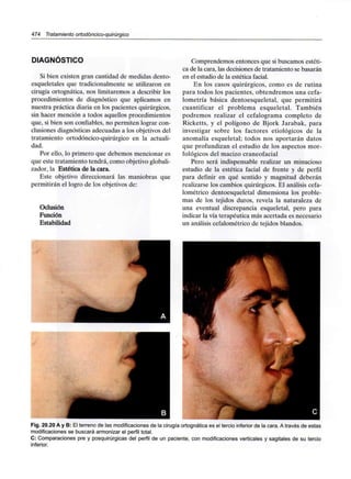 474 Tratamiento ortodóncico-quirúrgico
DIAGNÓSTICO
Si bien existen gran cantidad de medidas dento-
esqueletales que tradicionalmente se utilizaron en
cirugía ortognática, nos limitaremos a describir los
procedimientos de diagnóstico que aplicamos en
nuestra práctica diaria en los pacientes quirúrgicos,
sin hacer mención a todos aquellos procedimientos
que, si bien son confiables, no permiten lograr con-
clusiones diagnósticas adecuadas a los objetivos del
tratamiento ortodóncico-quirúrgico en la actuali-
dad.
Por ello, lo primero que debemos mencionar es
que este tratamiento tendrá, como objetivo globali-
zador, la Estética de la cara.
Este objetivo direccionará las maniobras que
permitirán el logro de los objetivos de:
Oclusión
Función
Estabilidad
Comprendemos entonces que si buscamos estéti-
ca de la cara, las decisiones de tratamiento se basarán
en el estudio de la estética facial.
En los casos quirúrgicos, como es de rutina
para todos los pacientes, obtendremos una cefa-
lometría básica dentoesqueletal, que permitirá
cuantificar el problema esqueletal. También
podremos realizar el cefalograma completo de
Ricketts, y el polígono de Bjork Jarabak, para
investigar sobre los factores etiológicos de la
anomalía esqueletal; todos nos aportarán datos
que profundizan el estudio de los aspectos mor-
fológicos del macizo craneofacial
Pero será indispensable realizar un minucioso
estudio de la estética facial de frente y de perfil
para definir en qué sentido y magnitud deberán
realizarse los cambios quirúrgicos. El análisis cefa-
lométrico dentoesqueletal dimensiona los proble-
mas de los tejidos duros, revela la naturaleza de
una eventual discrepancia esqueletal, pero para
indicar la vía terapéutica más acertada es necesario
un análisis cefalométrico de tejidos blandos.
Fig. 20.20 A y B: El terreno de las modificacionesde la cirugía ortognática es el tercio inferior de la cara.A través de estas
modificaciones se buscará armonizar el perfiltotal.
C: Comparaciones pre y posquirúrgicasdel perfil de un paciente, con modificacionesverticales y sagitales de su tercio
inferior.
 