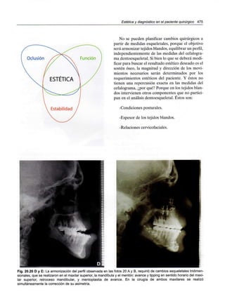 Estética y diagnóstico en el paciente quirúrgico 475
No se pueden planificar cambios quirúrgicos a
partir de medidas esqueletales, porque el objetivo
será armonizar tejidos blandos, equilibrar un perfil,
independientemente de las medidas del cefalogra-
ma dentoesqueletal. Si bien lo que se deberá modi-
ficar para buscar el resultado estético deseado es el
sostén óseo, la magnitud y dirección de los movi-
mientos necesarios serán determinados por los
requerimientos estéticos del paciente. Y éstos no
tienen una repercusión exacta en las medidas del
cefalograma, ¿por qué? Porque en los tejidos blan-
dos intervienen otros componentes que no partici-
pan en el análisis dentoesqueletal. Éstos son:
-Condiciones posturales.
-Espesor de los tejidos blandos.
-Relaciones cervicofaciales.
Fig. 20.20 D y E: La armonización del perfil observada en las fotos 20 A y B, requirió de cambios esqueletales tridimen-
sionales, que se realizaron en el maxilar superior, la mandíbula y el mentón: avance y tipping en sentido horario del maxi-
lar superior, retroceso mandibular, y mentoplastia de avance. En la cirugía de ambos maxilares se realizó
simultáneamente la corrección de su asimetría.
 