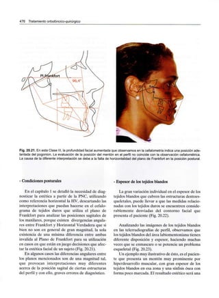 476 Tratamiento ortodóncico-quirúrgico
Fig. 20.21. En esta Clase III, la profundidad facial aumentada que observamos en la cefalometría indica una posición ade-
lantada del pogonion. La evaluación de la posición del mentón en el perfil no coincide con la observación cefalométrica.
La causa de la diferente interpretación se debe a la falta de horizontalidad del plano de Frankfort en la posición postural.
- Condiciones posturales
En el capítulo 1 se detalló la necesidad de diag-
nosticar la estética a partir de la PNC, utilizando
como referencia horizontal la HV, descartando las
interpretaciones que puedan hacerse en el cefalo-
grama de tejidos duros que utiliza el plano de
Frankfort para analizar las posiciones sagitales de
los maxilares, porque existen divergencias angula-
res entre Frankfort y Horizontal Verdadera que si
bien no son en general de gran magnitud, la sola
existencia de una mínima diferencia entre ambas
invalida al Plano de Frankfort para su utilización
en casos en que están en juego decisiones que afec-
tar la estética facial de un sujeto (Fig. 20.21).
En algunos casos las diferencias angulares entre
los planos mencionados son de una magnitud tal,
que provocan interpretaciones muy diferentes
acerca de la posición sagital de ciertas estructuras
del perfil y con ello, graves errores de diagnóstico.
- Espesor de los tejidos blandos
La gran variación individual en el espesor de los
tejidos blandos que cubren las estructuras dentoes-
queletales, puede llevar a que las medidas relacio-
nadas con los tejidos duros se encuentren conside-
rablemente desviadas del contorno facial que
presenta el paciente (Fig. 20.22).
Analizando las imágenes de los tejidos blandos
en las telerradiografías de perfil, observamos que
los tejidos blandos del área labiomentoniana tienen
diferente disposición y espesor, haciendo muchas
veces que se enmascare o se potencie un problema
esqueletal (Fig. 20.23).
Un ejemplo muy ilustrativo de ésto, es el pacien-
te que presenta un mentón muy prominente por
hiperdesarrollo muscular, con gran espesor de los
tejidos blandos en esa zona y una sínfisis ósea con
forma poco marcada. El resultado estético será una
 