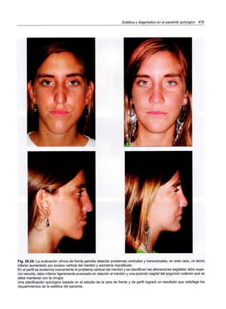 Estética y diagnóstico en el paciente quirúrgico 479
Fig. 20.24: La evaluación clínica de frente permite detectar problemas verticales y transversales, en este caso, un tercio
inferior aumentado por exceso vertical del mentón y asimetría mandibular.
En el perfil se evidencia nuevamente el problema vertical del mentón y se identifican las alteraciones sagitales: labio supe-
rior retruido, labio inferior ligeramente avanzado en relación al mentón y una posición sagital del pogonion cutáneo que se
debe mantener con la cirugía.
Una planificación quirúrgica basada en el estudio de la cara de frente y de perfil logrará un resultado que satisfaga los
requerimientos de la estética del paciente.
 