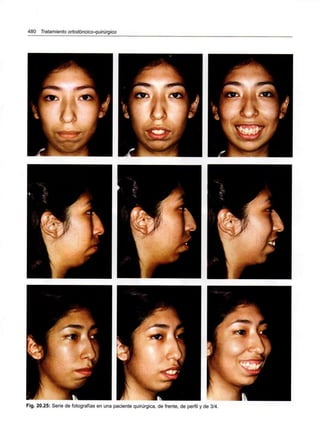 480 Tratamiento ortodóncico-quirúrgico
Fig. 20.25: Serie de fotografías en una paciente quirúrgica, de frente, de perfil y de 3/4.
 