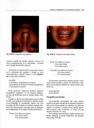 Estética y diagnósticoen el paciente quirúrgico 481
Fig. 20.26 A: Fotografía axial superior. Fig. 20.26 A: Fotografía sectorizada inferior.
vertical o sagital del maxilar superior y buscar un
efecto compensatorio en la mandíbula, evitando
así la cirugía del maxilar superior.
Al abordar el examen facial es necesario referir-
nos a conceptos del capítulo 1, donde se trató
extensamente el estudio clínico, y a las condicio-
nes en que debe realizarse.
- En PNC
- Con labios y musculatura en reposo
- En posición de Relación Céntrica mandibular
- Con contacto dentario.
Estos pacientes requieren también registros
fotográficos completos, en las mismas condicio-
nes que las detalladas para el estudio clínico (Fig.
20.25).
Cuando se observe una discrepancia entre la MIC
y la RC, para asegurar la posición de relación céntica
en las fotografías se recomienda colocar una cera
de registro de RC tomado en el primer contacto den-
tario, convenientemente recortada para no distorsio-
nar la disposición de los tejidos blandos peribucales.
- Frente: Con labios en reposo
Con cierre labial
Con sonrisa plena
Perfil: Con labios en reposo
Con cierre labial
Con sonrisa plena
3/4 perfil: Con labios en reposo
Con cierre labial
Con sonrisa plena
En pacientes asimétricos además, pueden regis-
trarse ambos perfiles y ambos 3/4 del perfil, y tam-
bién son de mucha utilidad las tomas axiales (Fig.
20.26 A):
Axial superior
Axial inferior
Fotografías sectorizadas:
Las fotografías sectorizadas del tercio inferior
permiten un mejor estudio de las relaciones labioden-
tales y de las líneas medias. Se registran con labios en
reposo y en sonrisa, y cuando no hay espacio interla-
bial en reposo o éste es mínimo, se toman con una
apertura bucal de 3 a 5 mm.
Para estudiar mejor las líneas medias dntarias y los
planos oclusales, se puede fotografiar una apertura
mayor (Fig. 20.26 B).
 