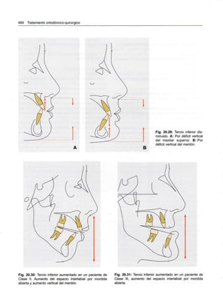 484 Tratamiento ortodóncico-quirúrgico
B
Fig. 20.29: Tercio inferior dis-
minuido. A: Por déficit vertical
del maxilar superior. B: Por
déficit vertical del mentón.
Fig. 20.30: Tercio inferior aumentado en un paciente de
Clase II. Aumento del espacio interlabial por mordida
abierta y aumento vertical del mentón.
Fig. 20.31: Tercio inferior aumentado en un paciente de
Clase III, aumento del espacio interlabial por mordida
abierta.
 