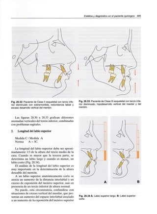 Estética y diagnóstico en el paciente quirúrgico 485
Fig. 20.32: Paciente de Clase II esqueletal con tercio infe-
rior disminuido con sobremordida, redundancia labial y
escaso desarrollo vertical del mentón.
Fig. 20.33: Paciente de Clase III esqueletal con tercio infe-
rior disminuido, hipodesarrollo vertical del maxilar y del
mentón.
Las figuras 20.30 a 20.33 grafican diferentes
anomalias verticales del tercio inferior, combinadas
con problemas sagitales.
2. Longitud del labio superior
Medida C / Medida A
Norma A = 3C.
La longitud del labio superior debe ser aproxi-
madamente 1/3 de la altura del tercio medio de la
cara. Cuando es mayor que la tercera parte, se
determina un labio largo y cuando es menor, un
labio corto (Fig. 20.34).
El análisis de la longitud del labio superior es
muy importante en la determinación de la altura
deseable del mentón.
A un labio superior anatómicamente corto se
asocia un aumento de la distancia interlabial y un
exceso de exposición del incisivo superior, aun en
presencia de un tercio inferior de altura normal.
No puede, esta circunstancia, confundirse con
situaciones de exceso vertical del maxilar, que pre-
sentan un aumento del espacio interlabial asociado
a un aumento de la exposición del incisivo superior
B
Fig. 20.34 A: Labio superior largo. B: Labio superior
corto.
 