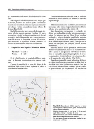 486 Tratamiento ortodóncico-quirúrgico
y a un aumento de la altura del tercio inferior de la
cara.
Si la longitud del labio superior fuera mayor que
la normal, la altura del mentón podrá también ser
mayor que la normal, para que se pueda mantener
un balance vertical adecuado del tercio inferior de
la cara (Fig. 20.35).
Si el labio superior fuera largo y la distancia sto-
mion inferior-mentón cutáneo (medida D) fuera
normal, no existirá un balance satisfactorio. Por el
contrario, si el labio superior fuera corto, puede ser
deseable acortar la dimensión vertical del mentón,
para mantener el equilibrio vertical, teniendo en
cuenta las dimensiones del tercio facial medio.
3. Longitud del labio superior / Altura del mentón
Medida C / Medida D
Norma D = 2C
Es la relación entre la longitud del labio supe-
rior y la distancia stomion inferior a mentón cutá-
neo.
Cuando la medida D es más del doble de la
medida C indica que el labio superior es corto, o
que el mentón es excesivo.
Cuando D es menos del doble de C el paciente
presenta un déficit vertical del mentón, o un labio
superior largo.
El labio inferior corto anatómico, se asocia con
frecuencia a las Clases II; por el contrario el labio
inferior largo anatómico a las Clases III.
Las alteraciones secundarias y posturales no
deben ser confundidas con las alteraciones anató-
micas. Por ejemplo, en una Clase II con mordida
profunda y altura dentaria mandibular anterior
normal, la interferencia de los incisivos superiores,
da al labio la apariencia de corto. Esta apariencia
podrá ser corregida, por ejemplo, con un avance
mandibular.
El labio inferior puede presentar también una
disminución en su altura cuando se encuentra ever-
tido, a causa de una posición retruida del mentón.
Esto es corregidos mediante genioplastia de avan-
ce, que mejora el soporte labial y produce una efec-
to de ascenso del labio inferior (Fig. 20.36).
Cuando no es posible medir la longitud del labio
al existir interferencias posturales, se debe abrir la
mordida hasta que los labios se separen. Son los
casos de un contacto labial excesivo, que se produ-
ce generalmente por la presencia de un maxilar
Fig. 20.35: Caso donde el labio superior es largo
con respecto al tercio medio, pero proporcionado
dentro del tercio inferior.
El labio superior mide 24 mm; es la 1/2 de la medi-
da D (labio inferior y mentón: 48 mm).
La desproporción con el tercio medio se debe a que
éste tiene un escaso desarrollo vertical.
No podría planificarse en este caso igualar los ter-
cios medio e inferior.
 