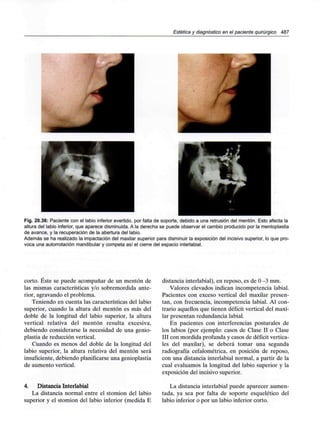 Estética y diagnóstico en el paciente quirúrgico 487
Fig. 20.36: Paciente con el labio inferior evertido, por falta de soporte, debido a una retrusión del mentón. Esto afecta la
altura del labio inferior, que aparece disminuida. Ala derecha se puede observar el cambio producido por la mentoplastia
de avance, y la recuperación de la abertura del labio.
Además se ha realizado la impactación del maxilar superior para disminuir la exposición del incisivo superior, lo que pro-
voca una autorrotación mandibular y competa así el cierre del espacio interlabial.
corto. Éste se puede acompañar de un mentón de
las mismas características y/o sobremordida ante-
rior, agravando el problema.
Teniendo en cuenta las características del labio
superior, cuando la altura del mentón es más del
doble de la longitud del labio superior, la altura
vertical relativa del mentón resulta excesiva,
debiendo considerarse la necesidad de una genio-
plastia de reducción vertical.
Cuando es menos del doble de la longitud del
labio superior, la altura relativa del mentón será
insuficiente, debiendo planificarse una genioplastia
de aumento vertical.
4. Distancia Interlabial
La distancia normal entre el stomion del labio
superior y el stomion del labio inferior (medida E
distancia interlabial), en reposo, es de O -3 mm.
Valores elevados indican incompetencia labial.
Pacientes con exceso vertical del maxilar presen-
tan, con frecuencia, incompetencia labial. Al con-
trario aquellos que tienen déficit vertical del maxi-
lar presentan redundancia labial.
En pacientes con interferencias posturales de
los labios (por ejemplo: casos de Clase II o Clase
III con mordida profunda y casos de déficit vertica-
les del maxilar), se deberá tomar una segunda
radiografía cefalométrica, en posición de reposo,
con una distancia interlabial normal, a partir de la
cual evaluamos la longitud del labio superior y la
exposición del incisivo superior.
La distancia interlabial puede aparecer aumen-
tada, ya sea por falta de soporte esquelético del
labio inferior o por un labio inferior corto.
 