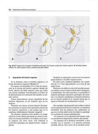 488 Tratamiento ortodóncico-quirúrgico
B
Fig. 20.37: Causas de un espacio interlabial aumentado. A: Exceso vertical del maxilar superior. B: Mordida abierta
anterior. C: Labio superior corto y eversión del labio inferior.
5. Exposición del incisivo superior
Es la distancia entre el stomion superior y el
borde del incisivo superior (Medida F).
En reposo, son deseables 2,5 a 4 mm de exposi-
ción de la corona del incisivo superior debajo del
borde inferior del labio superior, para que exista
una sonrisa armónica. Esta distancia es la llave de
la determinación de la posición del maxilar en sen-
tido vertical.
Existe, generalmente, menor exposición de los
incisivos superiores en los hombres que en las
mujeres.
Pacientes con exceso vertical anterior del maxi-
lar, presentan en reposo una exposición excesiva de
los incisivos superiores y una sonrisa que no es
armónica, habitualmente llamada "gingival".
No obstante, debemos estar atentos a la longi-
tud de la corona clínica que puede ser corta en rela-
ción a la corona anatómica y se traduce en un exce-
so gingival. En estos casos, está indicada la
corrección quirúrgica por gingivectomía / gingivo-
plastia.
También la exposición excesiva de los incisivos
puede deberse a un labio superior corto.
En estos casos, podemos planificar una exposi-
ción de 4 o 5 mm especialmente si se trata de una
mujer joven.
Pacientes con déficit vertical del maxilar presen-
tan muchas veces el aspecto facial tipico del pacien-
te desdentado. En estos pacientes, es preferible la
solución quirúrgica (descenso quirúrgico del maxi-
lar) a la solución ortodóncica (extrusión dentaria),
por la mejoría global de la armonía facial que se
asocia al aumento de su dimensión vertical.
Dos medidas fundamentales del análisis vertical
son la exposición del incisivo superior y la distancia
interlabial. Son las primeras que analizamos, ya
que nos revelan cuáles serán los objetivos quirúrgi-
cos verticales de nuestra planificación:
-Un aumento en la exposición del incisivo indi-
ca necesidad de impactación anterior del maxilar
-Un aumento de la distancia interlabial, o bien
coexiste con lo anterior, o el paciente presenta
mordida abierta. Este cierre de la mordida consti-
 