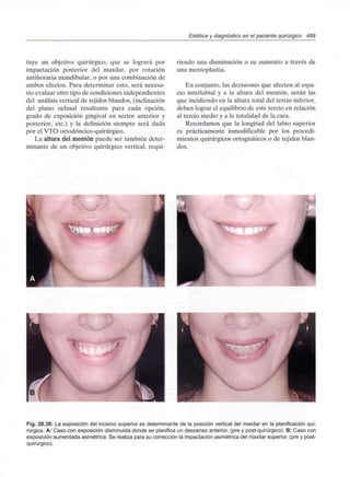 Estética y diagnóstico en el paciente quirúrgico 489
tuye un objetivo quirúrgico, que se logrará por
impactación posterior del maxilar, por rotación
antihoraria mandibular, o por una combinación de
ambos efectos. Para determinar esto, será necesa-
rio evaluar otro tipo de condiciones independientes
del análisis vertical de tejidos blandos, (inclinación
del plano oclusal resultante para cada opción,
grado de exposición gingival en sector anterior y
posterior, etc.) y la definición siempre será dada
por el VTO ortodóncico-quirúrgico.
La altura del mentón puede ser también deter-
minante de un objetivo quirúrgico vertical, requi-
riendo una disminución o su aumento a través de
una mentoplastia.
En conjunto, las decisiones que afecten al espa-
cio interlabial y a la altura del mentón, serán las
que incidiendo en la altura total del tercio inferior,
deben lograr el equilibrio de este tercio en relación
al tercio medio y a la totalidad de la cara.
Recordamos que la longitud del labio superior
es prácticamente inmodificable por los procedi-
mientos quirúrgicos ortognáticos o de tejidos blan-
dos.
Fig. 20.38: La exposición del incisivo superior es determinante de la posición vertical del maxilar en la planificación qui-
rúrgica. A: Caso con exposición disminuida donde se planifica un descenso anterior, (pre y post-quirúrgico). B: Caso con
exposición aumentada asimétrica. Se realiza para su corrección la impactación asimétrica del maxilar superior, (pre y post-
quirúrgico).
 