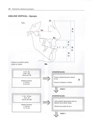 490 Tratamiento ortodóncico-quirúrgico
ANÁLISIS VERTICAL - Ejemplo
L.L.
Cabeza en posición natural
Labios en reposo Me
A: Gl - Sn
B:Sn - Me
Norma: A = B
Medida paciente:
A: 75 mm.
B: 84 mm.
C: Sn - St sup.
A:GI-Sn
Norma: A = 3C
Medida paciente:
C: 24 mm.
A: 75 mm.
INTERPRETACIÓN
Exceso vertical del tercio inferior:
9 mm.
Espacio interlabial o Sínfisis
PASO 2
INTERPRETACIÓN
Labio superior ligeramente corto en
relación con el tercio medio.
(Tendría que medir 25 mm).
PASOS
 