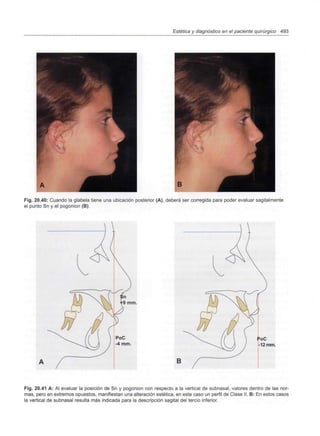 Estética y diagnóstico en el paciente quirúrgico 493
Fig. 20.40: Cuando la glabela tiene una ubicación posterior (A), deberá ser corregida para poder evaluar sagitalmente
el punto Sn y el pogonion (B).
Fig. 20.41 A: Al evaluar la posición de Sn y pogonion con respecto a la vertical de subnasal, valores dentro de las nor-
mas, pero en extremos opuestos, manifiestan una alteración estética, en este caso un perfil de Clase II. B: En estos casos
la vertical de subnasal resulta más indicada para la descripción sagital del tercio inferior.
 