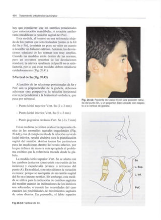 494 Tratamiento ortodóncico-quirúrgico
hay que considerar que los cambios rotacionales
(por autorrotación mandibular, o rotación antiho-
raria) modifican la posición sagital del PoC.
Esta medida, al basarse en una referencia aleja-
da de los puntos que son evaluados (como es la Gl
del Sn y Po), desvirtúa un poco su valor en cuanto
a describir un balance estético. Además, las desvia-
ciones standard de las normas son muy amplias.
Cuando las medidas están dentro de las normas,
pero en extremos opuestos de las desviaciones
standard, la estética resultante del perfil no es satis-
factoria, por lo que estas medidas deben estudiarse
cuidadosamente (Fig. 20.41).
2-Vertical de Sn (Fig. 20.43)
Al análisis de las relaciones posicionales de Sn y
PoC con la perpendicular de la glabela, debemos
adicionar otra perspectiva: la relación horizontal
con la perpendicular a la horizontal verdadera, que
pasa por subnasal.
- Punto labial superior-Vert. Sn (2 ± 2 mm)
- Punto labial inferior-Vert. Sn (O ± 2 mm)
- Punto pogonion cutáneo-Vert. Sn (-2± 2 mm)
Estas medidas permiten evaluar la expresión clí-
nica de las anomalías sagitales esqueletales (Fig.
20.44) y con el complemento de la relación cervical-
facial inferior, resulta decisiva para la planificación
sagital del mentón. Ambas toman los parámetros
para las mediciones dentro del tercio inferior, por
lo que definen de manera más apropiada el proble-
ma estético que la referencia trazada desde la gla-
bela.
La medida labio superior-Vert. Sn se afecta con
los cambios dentarios (protrusión o retrusión de los
incisivos) y esqueletales (avance o retroceso del
punto A). En realidad, con estos últimos lavariación
es menor, porque se acompaña de un cambio sagital
del Sn en el mismo sentido. Sin embargo, esta medi-
da se utiliza para la indicación de cambios sagitales
del maxilar cuando las inclinaciones de los incisivos
son adecuadas, o cuando las necesidades del caso
exceden las posibilidades de movimientos sagitales
de estos dientes. En promedio, el labio superior
Fig 20.43: Vertical de Sn.
Fig. 20.42: Paciente de Clase III con una posición retrui-
da del punto Sn, y un pogonion bien ubicado con respec-
to a la vertical de glabela.
PoC
 