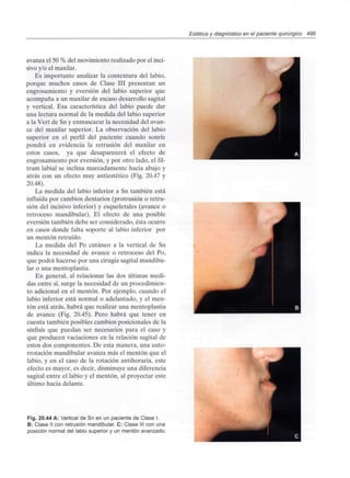 Estética y diagnóstico en el paciente quirúrgico 495
avanza el 50 % del movimiento realizado por el inci-
sivo y/o el maxilar.
Es importante analizar la contextura del labio,
porque muchos casos de Clase III presentan un
engrosamiento y eversión del labio superior que
acompaña a un maxilar de escaso desarrollo sagital
y vertical. Esa característica del labio puede dar
una lectura normal de la medida del labio superior
a la Vert de Sn y enmascarar la necesidad del avan-
ce del maxilar superior. La observación del labio
superior en el perfil del paciente cuando sonríe
pondrá en evidencia la retrusión del maxilar en
estos casos, ya que desaparecerá el efecto de
engrosamiento por eversión, y por otro lado, el fil-
trum labial se inclina marcadamente hacia abajo y
atrás con un efecto muy antiestético (Fig. 20.47 y
20.48).
La medida del labio inferior a Sn también está
influida por cambios dentarios (protrusión o retru-
sión del incisivo inferior) y esqueletales (avance o
retroceso mandibular). El efecto de una posible
eversión también debe ser considerado, ésta ocurre
en casos donde falta soporte al labio inferior por
un mentón retruído.
La medida del Po cutáneo a la vertical de Sn
indica la necesidad de avance o retroceso del Po,
que podrá hacerse por una cirugía sagital mandibu-
lar o una mentoplastia.
En general, al relacionar las dos últimas medi-
das entre sí, surge la necesidad de un procedimien-
to adicional en el mentón. Por ejemplo, cuando el
labio inferior está normal o adelantado, y el men-
tón está atrás, habrá que realizar una mentoplastia
de avance (Fig. 20.45). Pero habrá que tener en
cuenta también posibles cambios posicionales de la
sínfisis que puedan ser necesarios para el caso y
que producen vaciaciones en la relación sagital de
estos dos componentes. De esta manera, una auto-
rrotación mandibular avanza más el mentón que el
labio, y en el caso de la rotación antihoraria, este
efecto es mayor, es decir, disminuye una diferencia
sagital entre el labio y el mentón, al proyectar este
último hacia delante.
Fig. 20.44 A: Vertical de Sn en un paciente de Clase I.
B: Clase II con retrusión mandibular. C: Clase III con una
posición normal del labio superior y un mentón avanzado.
 