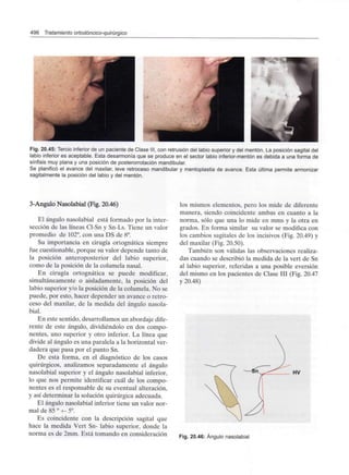 496 Tratamiento ortodóncico-quirúrgico
Fig. 20.45: Tercio inferior de un paciente de Clase III, con retrusión del labio superior y del mentón. La posición sagital del
labio inferior es aceptable. Esta desarmonía que se produce en el sector labio inferior-mentón es debida a una forma de
sínfisis muy plana y una posición de posterorrotación mandibular.
Se planificó el avance del maxilar, leve retroceso mandibular y mentoplastia de avance. Esta última permite armonizar
sagitalmente la posición del labio y del mentón.
3-Angulo Nasolabial (Fig. 20.46)
El ángulo nasolabial está formado por la inter-
sección de las líneas Cl-Sn y Sn-Ls. Tiene un valor
promedio de 102°, con una DS de 8°.
Su importancia en cirugía ortognática siempre
fue cuestionable, porque su valor depende tanto de
la posición anteroposterior del labio superior,
como de la posición de la columela nasal.
En cirugía ortognática se puede modificar,
simultáneamente o aisladamente, la posición del
labio superior y/o la posición de la columela. No se
puede, por esto, hacer depender un avance o retro-
ceso del maxilar, de la medida del ángulo nasola-
bial.
En este sentido, desarrollamos un abordaje dife-
rente de este ángulo, dividiéndolo en dos compo-
nentes, uno superior y otro inferior. La línea que
divide al ángulo es una paralela a la horizontal ver-
dadera que pasa por el punto Sn.
De esta forma, en el diagnóstico de los casos
quirúrgicos, analizamos separadamente el ángulo
nasolabial superior y el ángulo nasolabial inferior,
lo que nos permite identificar cuál de los compo-
nentes es el responsable de su eventual alteración,
y así determinar la solución quirúrgica adecuada.
El ángulo nasolabial inferior tiene un valor nor-
mal de 85 ° +- 5°.
Es coincidente con la descripción sagital que
hace la medida Vert Sn- labio superior, donde la
norma es de 2mm. Está tomando en consideración
los mismos elementos, pero los mide de diferente
manera, siendo coincidente ambas en cuanto a la
norma, sólo que una lo mide en mms y la otra en
grados. En forma similar su valor se modifica con
los cambios sagitales de los incisivos (Fig. 20.49) y
del maxilar (Fig. 20.50).
También son válidas las observaciones realiza-
das cuando se describió la medida de la vert de Sn
al labio superior, referidas a una posible eversión
del mismo en los pacientes de Clase III (Fig. 20.47
y 20.48)
Fig. 20.46: Ángulo nasolabial
 