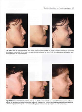 Estética y diagnóstico en el paciente quirúrgico 497
Fig. 20.47: Perfil de una paciente de Clase III con el labio superior evertido. El ángulo nasolabial inferior y la medida del
labio superior a la vertical de Sn. están normales, pero la inclinación del filtrum en la sonrisa pone de manifiesto la nece-
sidad de avance del maxilar superior.
Fig. 20.48: Post-quirúrgico de la paciente de la fig. 47, donde se ha realizado un avance del maxilar superior de 6 mm.
además del retroceso mandibular. Obsérvese que dicho avance no ha afectado tanto las medidas del ángulo nasolabial
y del labio superior con respecto a la vertical de Sn, pero es notorio en la observación del perfil con sonrisa.
 