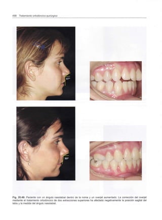 498 Tratamiento ortodóncico-quirúrgico
Fig. 20.49: Paciente con un ángulo nasolabial dentro de la noma y un overjet aumentado. La corrección del overjet
mediante el tratamiento ortodóncico de dos extracciones superiores ha afectado negativamente la posición sagital del
labio y la medida del ángulo nasolabial.
 