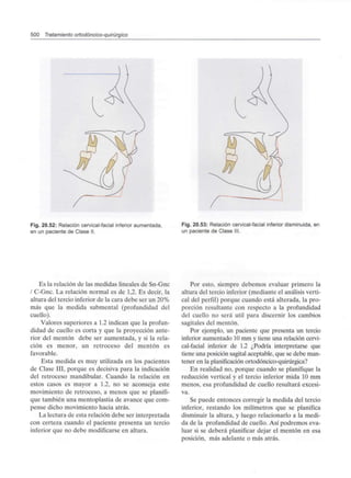 500 Tratamiento ortodóncico-quirúrgico
J
Fig. 20.52: Relación cervical-facial inferior aumentada,
en un paciente de Clase II.
Fig. 20.53: Relación cervical-facial inferior disminuida, en
un paciente de Clase III.
Es la relación de las medidas lineales de Sn-Gnc
/ C-Gnc. La relación normal es de 1,2. Es decir, la
altura del tercio inferior de la cara debe ser un 20%
más que la medida submental (profundidad del
cuello).
Valores superiores a 1.2 indican que la profun-
didad de cuello es corta y que la proyección ante-
rior del mentón debe ser aumentada, y si la rela-
ción es menor, un retroceso del mentón es
favorable.
Esta medida es muy utilizada en los pacientes
de Clase III, porque es decisiva para la indicación
del retroceso mandibular. Cuando la relación en
estos casos es mayor a 1.2, no se aconseja este
movimiento de retroceso, a menos que se planifi-
que también una mentoplastia de avance que com-
pense dicho movimiento hacia atrás.
La lectura de esta relación debe ser interpretada
con certeza cuando el paciente presenta un tercio
inferior que no debe modificarse en altura.
Por esto, siempre debemos evaluar primero la
altura del tercio inferior (mediante el análisis verti-
cal del perfil) porque cuando está alterada, la pro-
porción resultante con respecto a la profundidad
del cuello no será útil para discernir los cambios
sagitales del mentón.
Por ejemplo, un paciente que presenta un tercio
inferior aumentado 10 mm y tiene una relación cervi-
cal-facial inferior de 1.2 ¿Podría interpretarse que
tiene una posición sagital aceptable, que se debe man-
tener en la planificación ortodóncico-quirúrgica?
En realidad no, porque cuando se planifique la
reducción vertical y el tercio inferior mida 10 mm
menos, esa profundidad de cuello resultará excesi-
va.
Se puede entonces corregir la medida del tercio
inferior, restando los milímetros que se planifica
disminuir la altura, y luego relacionarlo a la medi-
da de la profundidad de cuello. Así podremos eva-
luar si se deberá planificar dejar el mentón en esa
posición, más adelante o más atrás.
 
