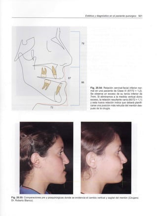 Estética y diagnóstico en el paciente quirúrgico 501
72
Fig. 20.54: Relación cervical-facial inferior nor-
mal en una paciente de Clase III (87/72 = 1,2).
Se observa un exceso de su tercio inferior de
7mm. Si eliminamos a la medida vertical dicho
exceso, la relación resultante varía (80/72 = 1,1)
y esta nueva relación indica que deberá planifi-
carse una posición más retruida del mentón des-
pués de la cirugía.
Fig. 20.55: Comparaciones pre y posquirúrgicas donde se evidencia el cambio vertical y sagital del mentón (Cirujano:
Dr. Roberto Blanco).
 