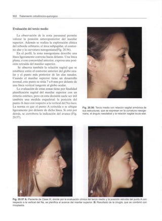 502 Tratamiento ortodóncico-quirúrgico
Evaluación del tercio medio
La observación de la zona paranasal permite
valorar la posición anteroposterior del maxilar
superior. Además se realiza la exploración clínica
del reborde orbitario, el área subpupilar,el contor-
no alar y la curvatura nasogeniana(Fig. 20.56).
En el perfil, la zona nasogeniana describe una
línea ligeramente convexa hacia delante. Una línea
plana, o con concavidad anterior, expresa una posi-
ción retruida del maxilar superior.
Se observa también la relación sagital que se
establece entre el contorno anterior del globo ocu-
lar y el punto más posterior de las alas nasales.
Cuando el maxilar superior tiene un desarrollo
normal, este punto se sitúa 7 u 8 mm por delante de
una línea vertical tangente al globo ocular.
La evaluación de estas zonas tiene por finalidad
planificación sagital del maxilar superior con un
criterio estético, pero en esta decisión suele ser útil
también una medida esqueletal: la posición del
punto A óseo con respecto a la vertical del Na óseo.
La norma es que el punto A coincida o se ubique
ligeramente por delante de dicha línea. Si está por
detrás, se corrobora la indicación del avance (Fig.
20.57).
Fig. 20.56: Tercio medio con relación sagital armónica de
sus estructuras, que se expresan en la curvatura nasoge-
niana, el ángulo nasolabial y la relación sagital óculo-alar.
Fig. 20.57 A: Paciente de Clase III, donde por la evaluación clínica del tercio medio y la posición retruida del punto A con
respecto a la vertical del Na, se planifica el avance del maxilar superior. B: Resultado de la cirugía, que se combinó con
rinoplastia.
 