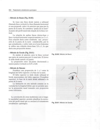 504 Tratamiento ortodóncico-quirúrgico
- Método deBaum (Fig. 20.60):
Se traza una línea desde nasion a subnasal
(llamada línea vertical).La línea llamada horizontal
es una perpendi- cular a la anterior que pasa por la
punta de la nariz. Se considera "punta de la nariz"
al punto del perfil nasal más elejado de la línea ver-
tical.
La relación de ambas líneas (dorso-base o
línea vertical-horizontal respectivamente) es 2 a 1.
Esta relación daría como resultante una proyec-
ción de la punta de la nariz considerable, por lo
que actualmente, y sobre todo en el sexo femenino
se utiliza una relación dorso-base 2,8 a 1, lo que
daría una proyección menor.
- Método deGoode (Fig. 20.61):
Es similar al anterior, pero la línea vertical
que parte de nasion pasa por el canal alar. El dorso
se mide desde nasion a la punta.
La proporción entre ala-punta (horizontal) y
nasion-punta (vertical) es 0,55 a 0,60.
- Método deSimons:
Establece una proporción de 1 a 1 entre la
longitud del labio superior y la base de la nariz.
El labio superior se mide desde subnasal al
borde mucocutáneo del labio superior (Vermilion
superior), la base de la nariz desde subnasal a la
punta de la nariz.
La limitación de este método consiste en la
variedad de la longitud labial, que no permite ajus-
tar la proyección nasal tomando esta proporción
como referencia.
La correlación de estas mediciones con el ángu-
lo nasolabial superior, permite planificar la correc-
ción del perfil nasal que se asociará al tratamiento
ortodóncico- quirúrgico.
Fig. 20.60: Método de Baum
Fig. 20.61: Método de Goode.
 
