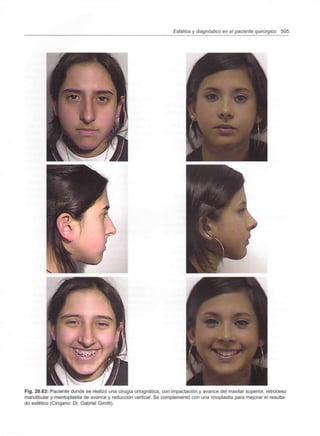 Estética y diagnóstico en el paciente quirúrgico 505
Fig. 20.63: Paciente donde se realizó una cirugía ortognática, con impactación y avance del maxilar superior, retroceso
mandibular y mentoplastia de avance y reducción vertical. Se complementó con una rinoplastia para mejorar el resulta-
do estético (Cirujano: Dr. Gabriel Girotti).
 