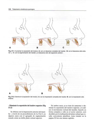 508 Tratamiento ortodóncico-quirúrgico
Fig. 21.1: Aumentar la exposición del incisivo. A: con un descenso completo del maxilar, B: con el descenso sólo ante-
rior y C: con la segmentación del maxilar y el descenso sólo del segmento anterior.
B
Fig. 21.2: Disminuir la exposición del incisivo. A: con la impactación completa del maxilar. B: con la impactación sólo
anterior.
- Disminuir la exposición del incisivo superior (Fig
21.2):
Se obtiene con la impactación anterior del maxi-
lar , a través de un procedimiento de Le Fort I, en
algunos casos con el agregado de segmentación
cuando existe un doble plano oclusal superior.
En ambos casos, ya se trate de aumentar o dis-
minuir la exposición del incisivo superior, al reali-
zar el movimiento vertical del maxilar, hacerlo en
forma completa o sólo en el sector anterior, será
decidido por la inclinación del plano oclusal que re-
sulte conveniente planificar, tema tratado en la
página 523 de este mismo capítulo.
 