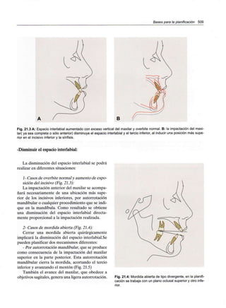 Bases para la planificación 509
Fig. 21.3 A: Espacio interlabial aumentado con exceso vertical del maxilar y overbite normal. B: la impactación del maxi-
lar( ya sea completa o sólo anterior) disminuye el espacio interlabial y el tercio inferior, al inducir una posición más supe-
rior en el incisivo inferior y la sínfisis.
-Disminuir el espacio interlabial:
La disminución del espacio interlabial se podrá
realizar en diferentes situaciones:
1- Casos de overbite normal y aumento de expo-
sición del incisivo (Fig. 21.3):
La impactación anterior del maxilar se acompa-
ñará necesariamente de una ubicación más supe-
rior de los incisivos inferiores, por autorrotación
mandibular o cualquier procedimiento que se indi-
que en la mandíbula. Como resultado se obtiene
una disminución del espacio interlabial directa-
mente proporcional a la impactación realizada.
2- Casos de mordida abierta (Fig. 21.4):
Cerrar una mordida abierta quirúrgicamente
implicará la disminución del espacio interlabial.Se
pueden planificar dos mecanismos diferentes:
- Por autorrotación mandibular, que se produce
como consecuencia de la impactación del maxilar
superior en la parte posterior. Esta autorrotación
mandibular cierra la mordida, acortando el tercio
inferior y avanzando el mentón (Fig. 21.5)
También el avance del maxilar, que obedece a
objetivos sagitales, genera una ligera autorrotación. Fig. 21.4: Mordida abierta de tipo divergente, en la planifi-
cación se trabaja con un plano oclusal superior y otro infe-
rior.
 