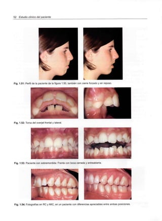 52 Estudio clínico del paciente
Fig. 1.51: Perfil de la paciente de la figura 1.50, también con cierre forzado y en reposo.
Fig. 1.52: Toma del overjet frontal y lateral.
Fig. 1.53: Paciente con sobremordida: Frente con boca cerrada y entreabierta.
"* "*-•' 'I'/í ' H , '' í
Fig. 1.54: Fotografías en RC y MIC, en un paciente con diferencias apreciables entre ambas posiciones.
 