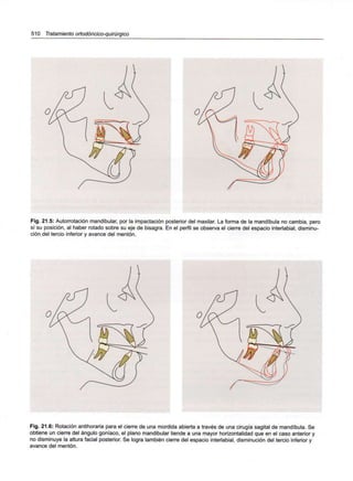 510 Tratamiento ortodóncico-quirúrgico
Fig. 21.5: Autorrotación mandibular, por la impactación posterior del maxilar. La forma de la mandíbula no cambia, pero
sí su posición, al haber rotado sobre su eje de bisagra. En el perfil se observa el cierre del espacio interlabial, disminu-
ción del tercio inferior y avance del mentón.
Fig. 21.6: Rotación antihoraria para el cierre de una mordida abierta a través de una cirugía sagital de mandíbula. Se
obtiene un cierre del ángulo goníaco, el plano mandibular tiende a una mayor horizontalidad que en el caso anterior y
no disminuye la altura facial posterior. Se logra también cierre del espacio interlabial, disminución del tercio inferior y
avance del mentón.
 