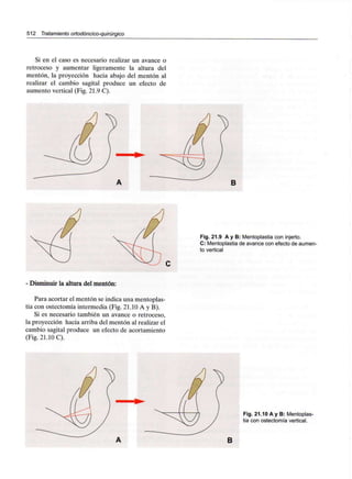 512 Tratamiento ortodóncico-quirúrgico
Si en el caso es necesario realizar un avance o
retroceso y aumentar ligeramente la altura del
mentón, la proyección hacia abajo del mentón al
realizar el cambio sagital produce un efecto de
aumento vertical (Fig. 21.9 C).
Fig. 21.9 A y B: Mentoplastia con injerto.
C: Mentoplastia de avance con efecto de aumen-
to vertical
- Disminuir la altura del mentón:
Para acortar el mentón se indica una mentoplas-
tia con ostectomía intermedia (Fig. 21.10 A y B).
Si es necesario también un avance o retroceso,
la proyección hacia arriba del mentón al realizar el
cambio sagital produce un efecto de acortamiento
(Fig. 21.10 C).
Fig. 21.10 A y B: Mentoplas-
tia con ostectomía vertical.
B
 