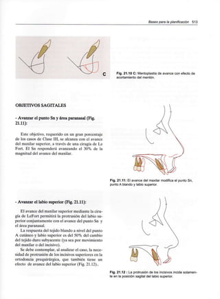Bases para la planificación 513
Fig. 21.10 C: Mentoplastia de avance con efecto de
acortamiento del mentón.
OBJETIVOS SAGITALES
- Avanzar el punto Sn y área paranasal (Fig.
21.11):
Este objetivo, requerido en un gran porcentaje
de los casos de Clase III,se alcanza con el avance
del maxilar superior, a través de una cirugía de Le
Fort. El Sn responderá avanzando el 30% de la
magnitud del avance del maxilar.
Fig. 21.11: El avance del maxilar modifica el punto Sn,
punto A blando y labio superior.
- Avanzar el labio superior (Fig. 21.11):
El avance del maxilar superior mediante la ciru-
gía de LeFort permitirá la protrusión del labio su-
perior conjuntamente con el avance del punto Sn y
el área paranasal.
La respuesta del tejido blando a nivel del punto
A cutáneo y labio superior es del 50% del cambio
del tejido duro subyacente (ya sea por movimiento
del maxilar o del incisivo).
Se debe contemplar, al analizar el caso, la nece-
sidad de protrusión de los incisivos superiores en la
ortodoncia prequirúrgica, que también tiene un
efecto de avance del labio superior (Fig. 21.12)..
Fig. 21.12 : La protrusión de los incisivos incide solamen-
te en la posición sagital del labio superior.
 