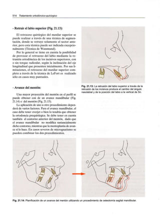 514 Tratamiento ortodóncico-quirúrgico
- Retruir el labio superior (Fig. 21.13):
El retroceso quirúrgico del maxilar superior se
puede realizar a través de una técnica de segmen-
tación, donde se retruye solamente el sector ante-
rior, pero esta técnica puede ser indicada excepcio-
nalmente (Técnica de Wassmund).
Por lo general se tiene en cuenta la posibilidad
de provocar el retroceso del labio mediante la re-
trusión ortodóncica de los incisivos superiores, con
o sin torque radicular, según la inclinación del eje
longitudinal que presenten inicialmente. Por sus li-
mitaciones, el retroceso del maxilar superior com-
pleto a través de la técnica de LeFort es realizado
sólo en casos muy puntuales.
- Avance del mentón:
Una mayor proyección del mentón en el perfil se
puede obtener con de un avance mandibular (Fig.
21.14) o del mentón (Fig. 21.15).
La aplicación de uno u otro procedimiento depen-
derá de varios factores. Para el avance mandibular, el
caso debe tener overjet o bien lo tendría que obtener
la ortodoncia prequirúrgica. Se debe tener en cuenta
también el contorno anterior del mentón, dado que
el avance mandibular no modifica sustancialmente
dicho contorno, mientras que la mentoplastia de avan-
ce sí lo hace. En casos severos de micrognatismo se
pueden combinar los dos procedimientos.
Fig. 21.13: La retrusión del labio superior a través de la
retrusión de los incisivos produce el cambio del ángulo
nasolabial y de la posición del labio a la vertical de Sn.
Fig. 21.14: Planificación de un avance del mentón utilizando un procedimiento de osteotomía sagital mandibular.
 