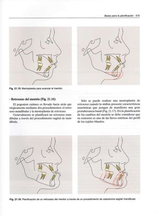 Bases para la planificación 515
Fig. 21.15: Mentoplastia para avanzar el mentón.
- Retroceso del mentón (Fig. 21.16):
El pogonion cutáneo es llevado hacia atrás qui-
rúrgicamente mediante dos procedimientos: el retro-
ceso mandibular y la mentoplastia de retroceso.
Generalmente se planificará un retroceso man-
dibular a través del procedimiento sagital de man-
díbula.
Sólo se puede realizar una mentoplastia de
retroceso cuando la sínfisis presente características
anatómicas que pongan de manifiesto una gran
protuberancia basal (Fig. 21.17). En la planificación
de los cambios del mentón se debe considerar que
su contorno es una de las llaves estéticas del perfil
de los tejidos blandos.
Fig. 21.16: Planificación de un retroceso del mentón a través de un procedimiento de osteotomía sagital mandibular.
 