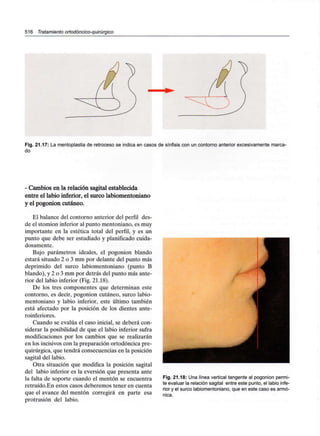 516 Tratamiento ortodóncico-quirúrgico
Fig. 21.17: La mentoplastia de retroceso se indica en casos de sínfisis con un contorno anterior excesivamente marca-
do
- Cambios en la relación sagital establecida
entre el labio inferior, el surco labiomentoniano
y el pogonion cutáneo.
El balance del contorno anterior del perfil des-
de el stomion inferior al punto mentoniano, es muy
importante en la estética total del perfil, y es un
punto que debe ser estudiado y planificadocuida-
dosamente.
Bajo parámetros ideales, el pogonion blando
estará situado 2 o 3 mm por delante del punto más
deprimido del surco labiomentoniano (punto B
blando), y 2 o 3 mm por detrás del punto más ante-
rior del labio inferior (Fig. 21.18).
De los tres componentes que determinan este
contorno, es decir, pogonion cutáneo, surco labio-
mentoniano y labio inferior, este último también
está afectado por la posición de los dientes ante-
roinferiores.
Cuando se evalúa el caso inicial, se deberá con-
siderar la posibilidad de que el labio inferior sufra
modificaciones por los cambios que se realizarán
en los incisivos con la preparación ortodóncica pre-
quirúrgica, que tendrá consecuencias en la posición
sagital del labio.
Otra situación que modifica la posición sagital
del labio inferior es la eversión que presenta ante
la falta de soporte cuando el mentón se encuentra
retruído.En estos casos deberemos tener en cuenta
que el avance del mentón corregirá en parte esa
protrusión del labio.
Fig. 21.18: Una línea vertical tangente al pogonion permi-
te evaluar la relación sagital entre este punto, el labio infe-
rior y el surco labiomentoniano, que en este caso es armó-
nica.
 
