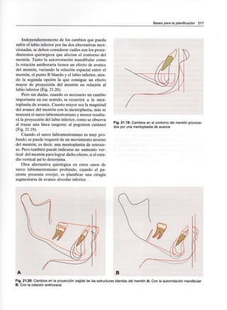 Bases para la planificación 517
Independientemente de los cambios que pueda
sufrir el labio inferior por las dos alternativas men-
cionadas, se deben considerar cuáles son los proce-
dimientos quirúrgicos que afectan el contorno del
mentón. Tanto la autorrotación mandibular como
la rotación antihoraria tienen un efecto de avance
del mentón, variando la relación espacial entre el
mentón, el punto B blando y el labio inferior, sien-
do la segunda opción la que consigue un efecto
mayor de proyección del mentón en relación al
labio inferior (Fig. 21.20).
Pero sin dudas, cuando es necesario un cambio
importante en ese sentido, se recurrirá a la men-
toplastia de avance. Cuanto mayor sea la magnitud
del avance del mentón con la mentoplastia, más se
marcará el surco labiomentoniano y menor resulta-
rá la proyección del labio inferior, como se observa
al trazar una línea tangente al pogonion cutáneo
(Fig. 21.19).
Cuando el surco labiomentoniano es muy pro-
fundo, se puede requerir de un movimiento inverso
del mentón, es decir, una mentoplastia de retroce-
so. Pero también puede indicarse un aumento ver-
tical del mentón para lograr dicho efecto, si el estu-
dio vertical así lo determina.
Otra alternativa quirúrgica en estos casos de
surco labiomentoniano profundo, cuando el pa-
ciente presenta overjet, es planificar una cirugía
segmentaria de avance alveolar inferior.
Fig. 21.19: Cambios en el contorno del mentón provoca-
dos por una mentoplastia de avance
B
Fig. 21.20: Cambios en la proyección sagital de las estructuras blandas del mentón A: Con la autorrotación mandibular
B: Con la rotación antihoraria.
 