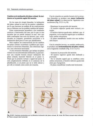 518 Tratamiento ortodóncico-quirúrgico
Cambios en la inclinación del plano oclusal. Su inci-
dencia en la posición sagital del mentón.
En los casos de cirugía bimaxilar, la inclinación
del plano oclusal es uno de los puntos a planificar,
por lo que haremos un análisis de las consecuencias
que se obtienen con los posibles cambios del mismo.
Estas consecuencias incumben a los resultados
estéticos y funcionales del caso, por lo que es una
decisión que no puede tomarse al azar, sino que
debe contemplar una serie de factores, que, consi-
derados en conjunto, permitirán acercarnos a la
inclinación ideal para el caso que planificamos.
Para explicar las consecuencias de los cambios
del plano oclusal, recurrimos a gráficos que repre-
sentan la estructura bimaxilar, una referencia sagi-
tal y una referencia horizontal.
A esta estructura bimaxilar, que incluye un plano
oclusal con una determinada inclinación,le generare-
mos una rotación horaria (mayor inclinación del
plano oclusal), haciendo fulcrum en el punto A.
Dado que la posición vertical y sagital del punto A
está completamente definida en el comienzo de la
planificación, es un punto que no se debe alterar y
por ello es tomado como centro de rotación.
Con la rotación en sentido horario de la estruc-
tura bimaxilar se produce una mayor inclinación
del plano oclusal y se observan las siguientes con-
secuencias (Fig. 21.21 A y B).
- Disminuye la proyección del mentón
- El incisivo superior queda más vertical y re-
truido.
- El incisivo inferior queda más adelante que el
pogonion, en la relación sagital que se establece
entre ambas estructuras.
- El plano mandibular resulta con una inclina-
ción mayor.
Con la rotación inversa, en sentido antihorario,
se produce una horizontalización del plano oclusal,
con el siguiente resultado (Fig. 21.21 A y C):
- Aumenta la proyección del mentón.
- El incisivo superior queda más inclinado y
protruido.
- En la relación sagital que se establece entre
ambas estructuras, el incisivo inferior queda más
atrás que el pogonion.
- El plano mandibular resulta más horizontal.
B
Fig. 21.21: Cambios producidos por la diferente inclinación del plano oclusal. A: Inicial B: Plano oclusal más inclinado
C: Plano oclusal más horizontal
 