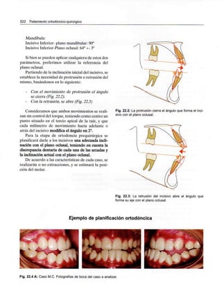 522 Tratamiento ortodóncico-quirúrgíco
Mandíbula:
Incisivo Inferior- plano mandibular:90°
Incisivo Inferior-Plano oclusal: 64° +- 3°
Si bien se pueden aplicar cualquiera de estos dos
parámetros, preferimos utilizar la referencia del
plano oclusal.
Partiendo de la inclinación inicial del incisivo,se
establece la necesidad de protrusión o retrusión del
mismo, basándonos en lo siguiente:
- Con el movimiento de protrusión el ángulo
se cierra (Fig. 22.2).
- Con la retrusión, se abre (Fig.22.3)
Consideramos que ambos movimientos se reali-
zan sin control del torque, teniendo como centro un
punto situado en el tercio apical de la raíz, y que
cada milímetro de movimiento hacia adelante o
atrás del incisivo modifica el ángulo en 2°.
Para la etapa de ortodoncia prequirúrgica se
planificará darle a los incisivos una adecuada incli-
nación con el plano oclusal, teniendo en cuenta la
discrepancia dentaria de cada una de las arcadas y
la inclinación actual con el plano oclusal.
De acuerdo a las características de cada caso, se
realizarán o no extracciones, y se estimará la posi-
ción del molar.
Fig. 22.2: La protrusión cierra el ángulo que forma el inci-
sivo con el plano oclusal.
Fig. 22.3: La retrusión del incisivo abre el ángulo que
forma su eje con el plano oclusal.
Ejemplo de planificación ortodóncica
i
Fig. 22.4 A: Caso M.C. Fotografías de boca del caso a analizar.
i-
 
