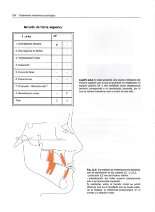 524 Tratamiento ortodóncico-quirúrgico
Arcada dentaria superior
1 - A-Po
1. Discrepancia dentaria
2. Discrepancia de Bolton
3. Verticalización molar
4. Expansión
5. Curva de Spee
6. Extracciones
7. Protrusión - Retrusión del 1
8. Mesialización molar
Total
57°
+
2*
-
-
-
-
-
-
-
2
-
-
-
-
-
-
-
2*
2
Cuadro 22.2: El caso presenta una buena inclinación del
incisivo superior, por lo que se planifica no modificarlo. El
espacio positivo de 2 mm señalado como discrepancia
dentaria corresponde a la hemiarcada izquierda, por lo
que se deberá mesializar sólo el molar de ese lado.
Fig. 22.6: Se realizan las modificaciones dentarias
que se planificaron en los cuadros 22.1 y 22.2:
- protrusión 3,5 mm del incisivo inferior.
- mesialización del molar superior (corresponde
solo a la hemiarcada izquierda).
Al realizarlas sobre el trazado inicial se podrá
observar cuál es el resultado que se puede espe-
rar al finalizar la ortodoncia prequirúrgica en el
overjet y la relación molar.
 